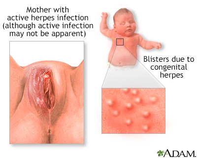 herpes mouth sores pictures. Birth-acquired herpes